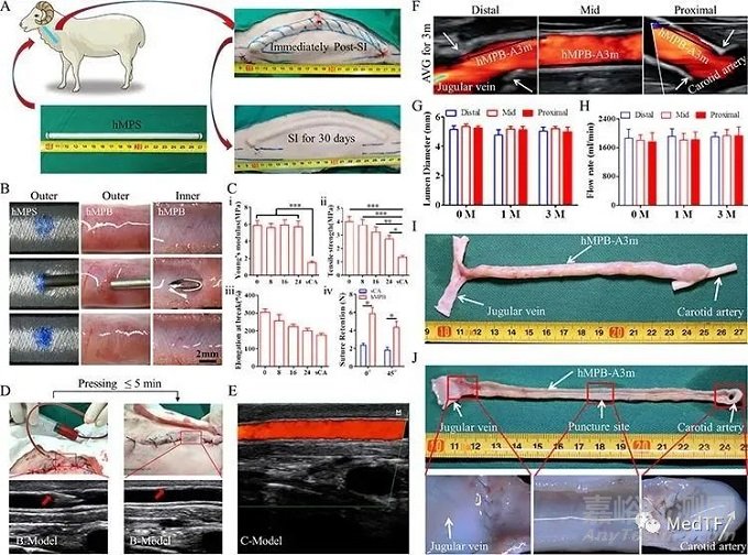 PULSSIBLE：生物型人工血管完成首例臨床入組